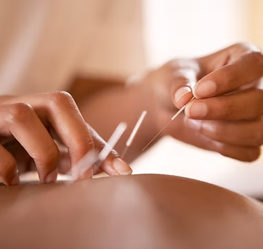 Acupuncture